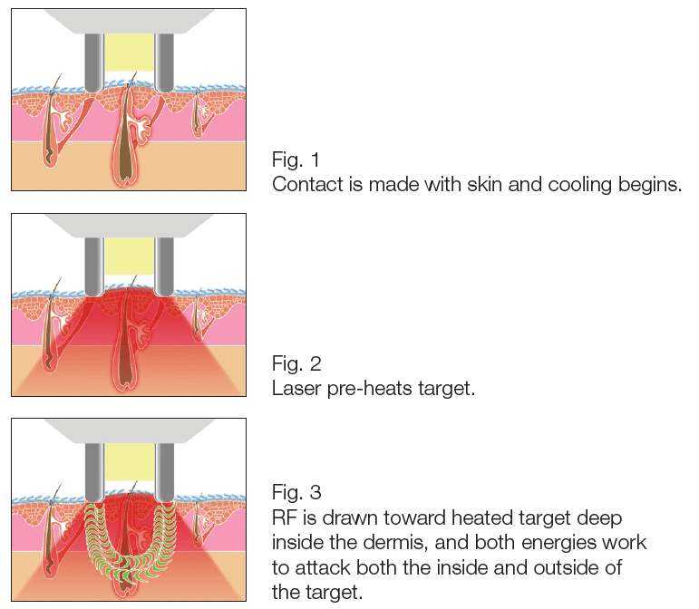 Laser Hair Removal Orange County Newport Beach