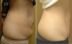 Cellulite-Reduction-Side-Before-After