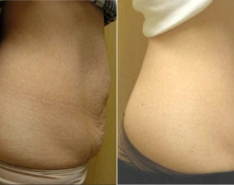 Velashape before and after photo