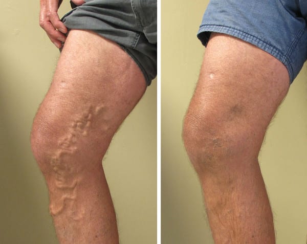 Before and after vein treatments