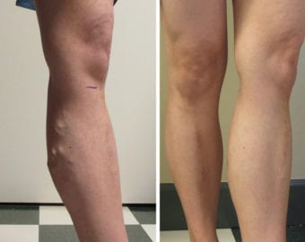 Before and after photograph of vein treatment