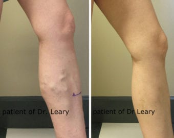 Before and after photograph of vein treatment by California Vein Specialists