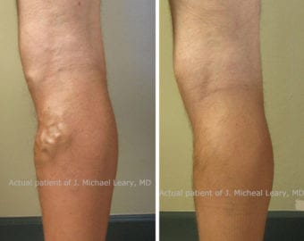 Before and after photograph of varicose vein treatment