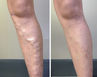 Before and after photo of vein treatment