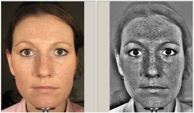 FotoFinder Facial Rejuvenation