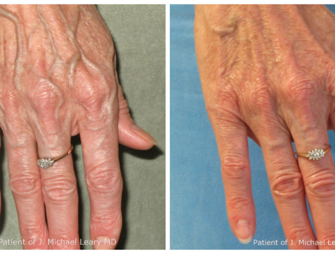 hand sclero closeup hand sclero closeup