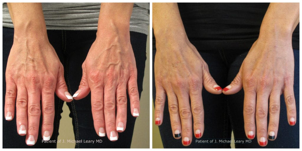 hand vein treatment before and after