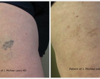 Sclerotherapy treatment before and after