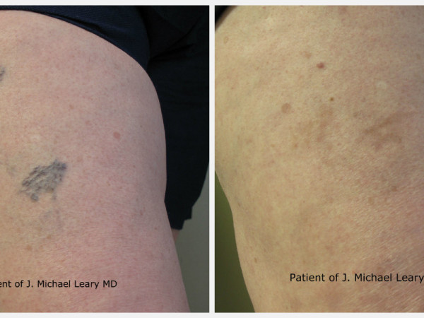 sclero_before_after_branded sclero_before_after_branded