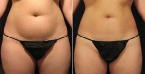 VelaShape3-review-before-after