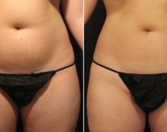 Velashape treatment before and after photo