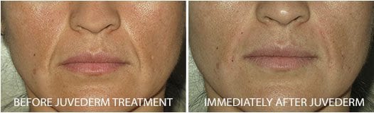 dremal fillers before and after