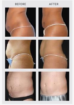 ultrashape before and after orange county