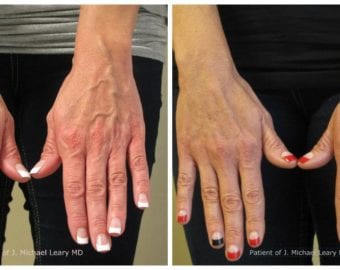 Vein treatment before and after