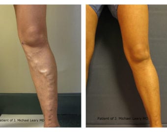 Vein treatment before and after