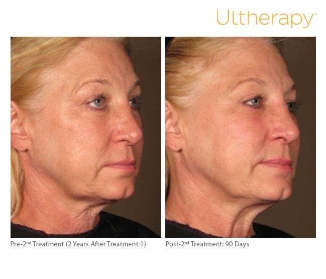 ultherapy patient orange county