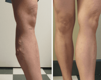vein treatment before and after