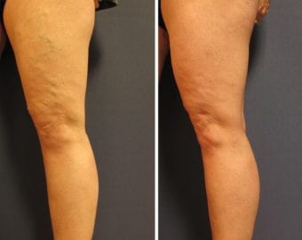 vein treatment before and after