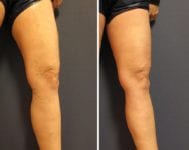 before-after-one-leg-right
