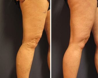 vein treatment before and after