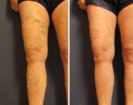 before-after-one-leg-right-3