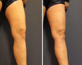 vein treatment before and after