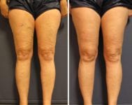 before-after-two-legs-front