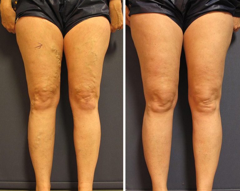 before_after_vv_front_leg EZ Veins Orange County Ca Vein Specialists