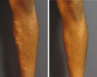 before_after_vv_front_leg