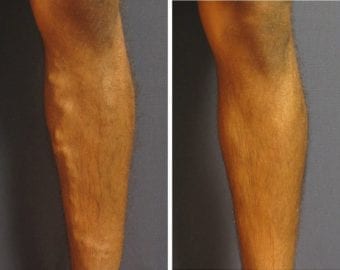 vein treatment before and after