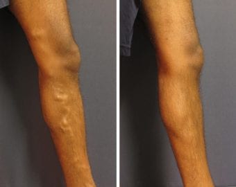 vein treatment before and after