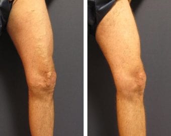 vein treatment before and after