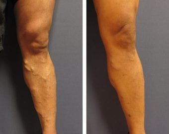 vein treatment before and after