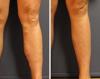 vein treatment before and after