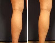 before-after_t-forbes_3