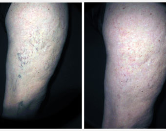 before and after vein treatment