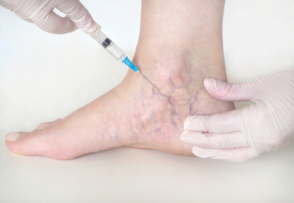 sclerotherapy patient