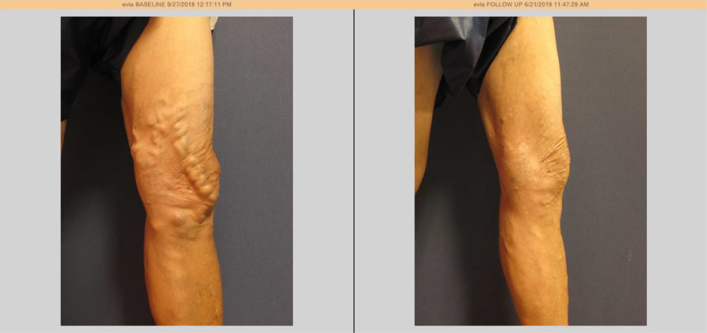 vein before and after