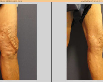 vein before and after