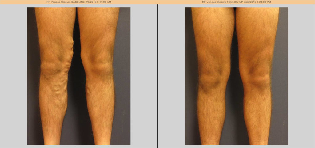 vein treatment before and after