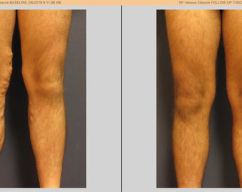 vein treatment before and after