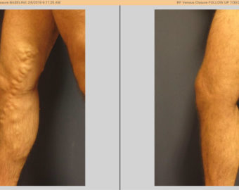 vein treatment patient