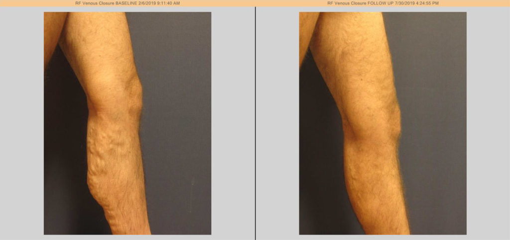 vein treatment before and after