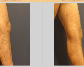 vein treatment before and after