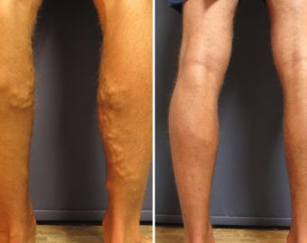 vein treatment before and after