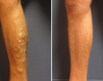 vein treatment before and after
