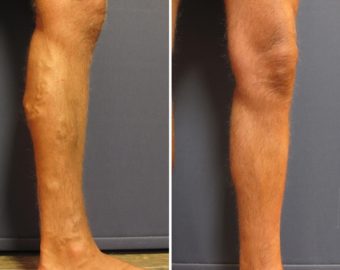 vein treatment before and after