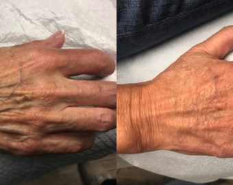 hand vein treatment patient