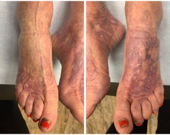 Before and after vein treatment
