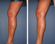 before-after-vein-treatment
